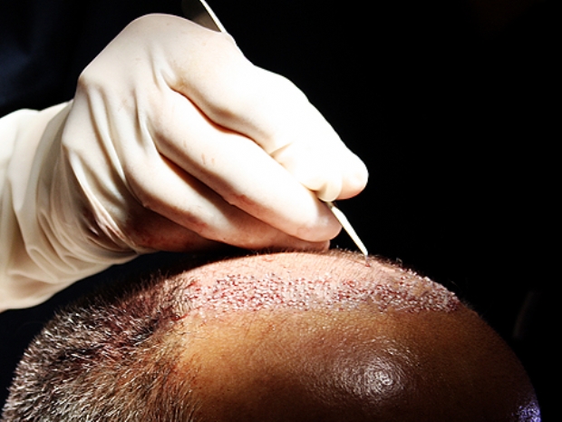 Organik saç ekimi saç sorunlarına kalıcı çözüm getiriyor